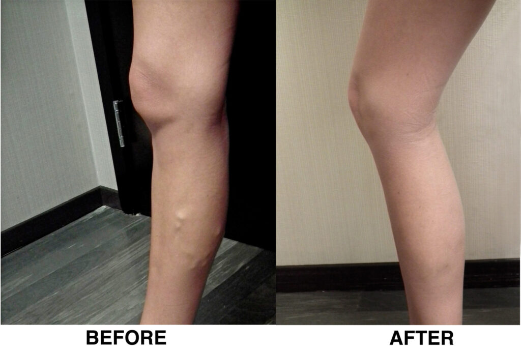 before and after vein treatment
