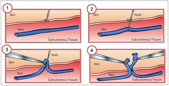Microphlebectomy procedure at Pura Vida Med Spa